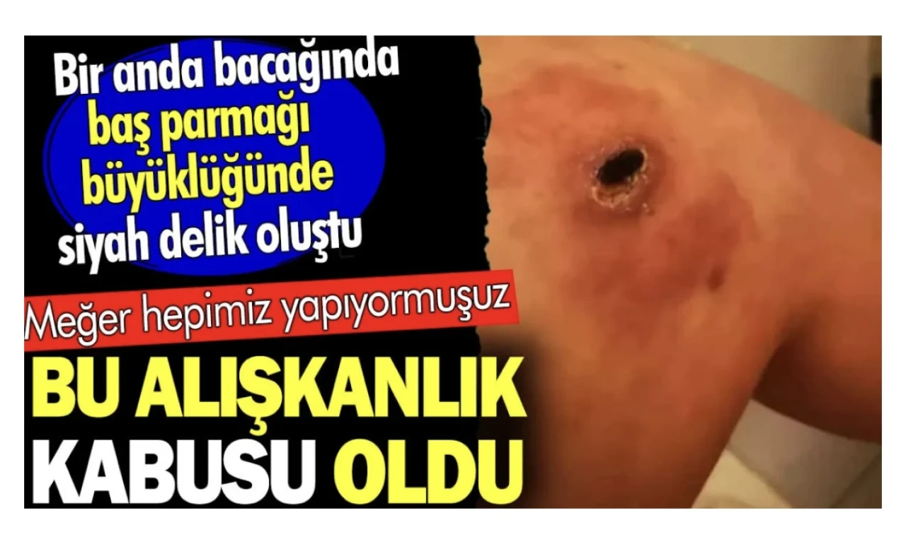 Bu alışkanlık kabusu oldu. Bir anda bacağında baş parmağı büyüklüğünde siyah delik oluştu